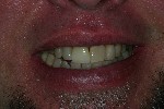 All Porcelain Crown - A Porcelain Fused to metal crown with an exposed metal margin was replaced with an all porcelain one