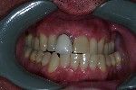 All Porcelain Crown - A Porcelain Fused to metal crown with an exposed metal margin was replaced with an all porcelain one
